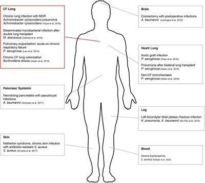 Overcoming Challenges to Make Bacteriophage Therapy Standard Clinical Treatment Practice for Cystic Fibrosis